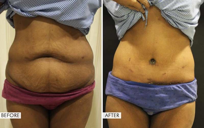 Shed Excess Waistline Fat With a Belt Lipectomy