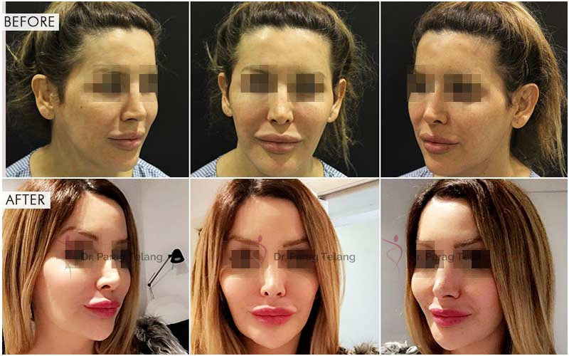 Jaw Surgery Before & After Photos - Law Plastic Surgery